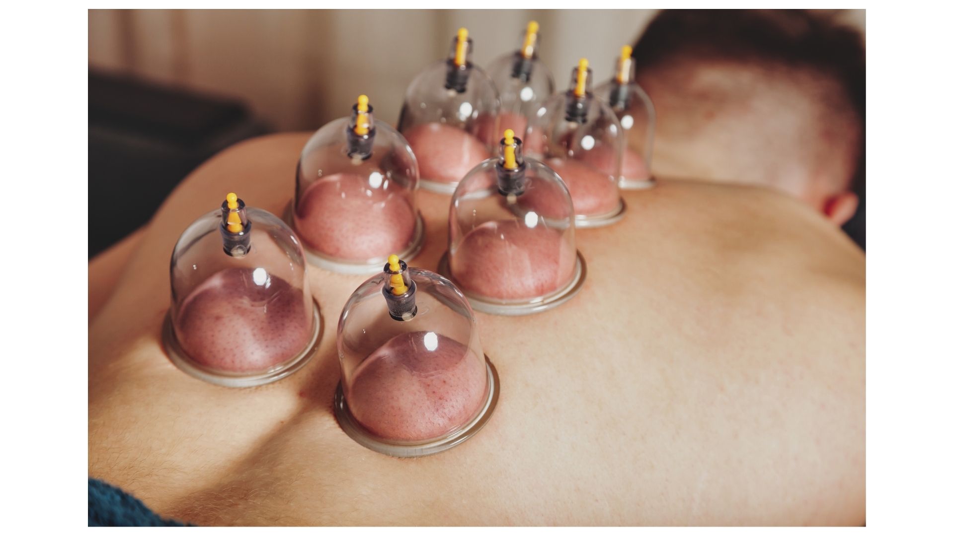 Cupping Therapy in Kansas City: Ancient Technique, Modern Recovery Results at Our North Kansas City Clinic Cupping Therapy in Kansas City: Ancient Technique, Modern Recovery Results at Our North Kansas City Clinic